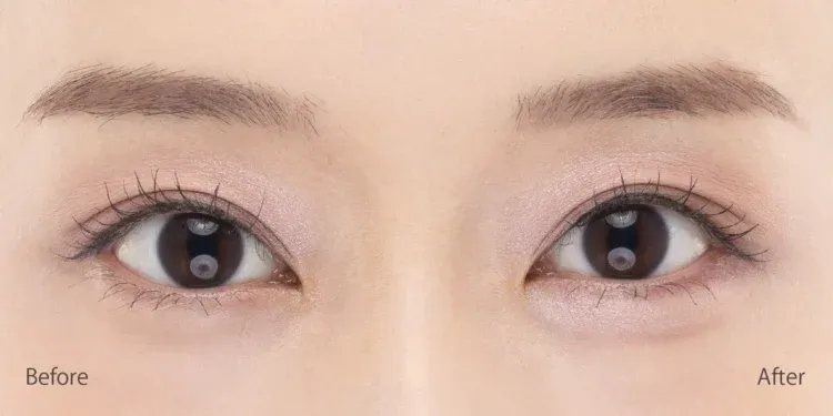 アンダーアイライナー Before After